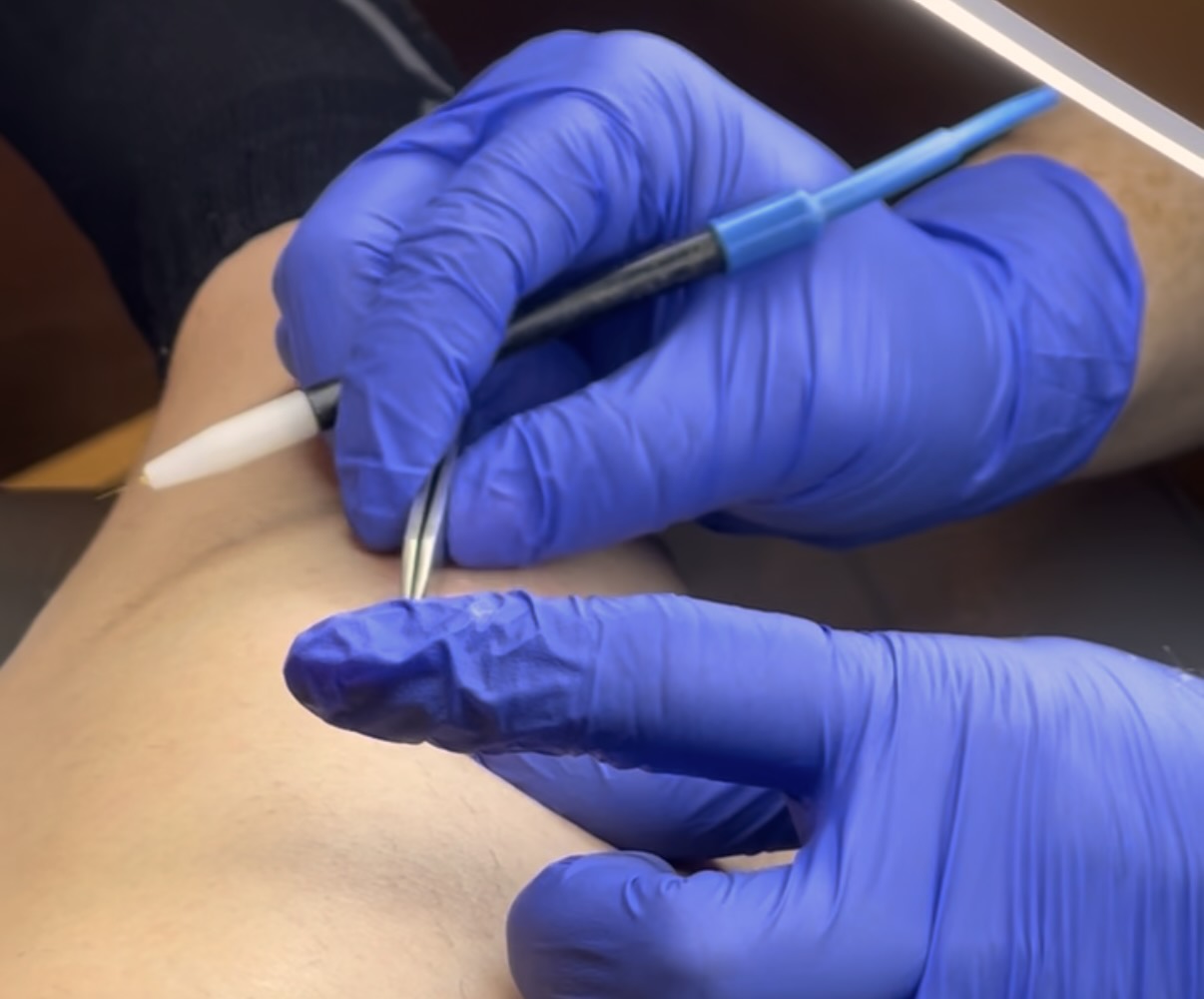 Gloved hand holding an electrolysis device to the upper lip during a face treatment, client relaxed on a table